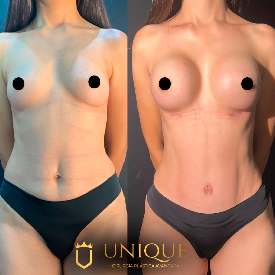 Antes e depois de Abdominoplastia HD na Unique